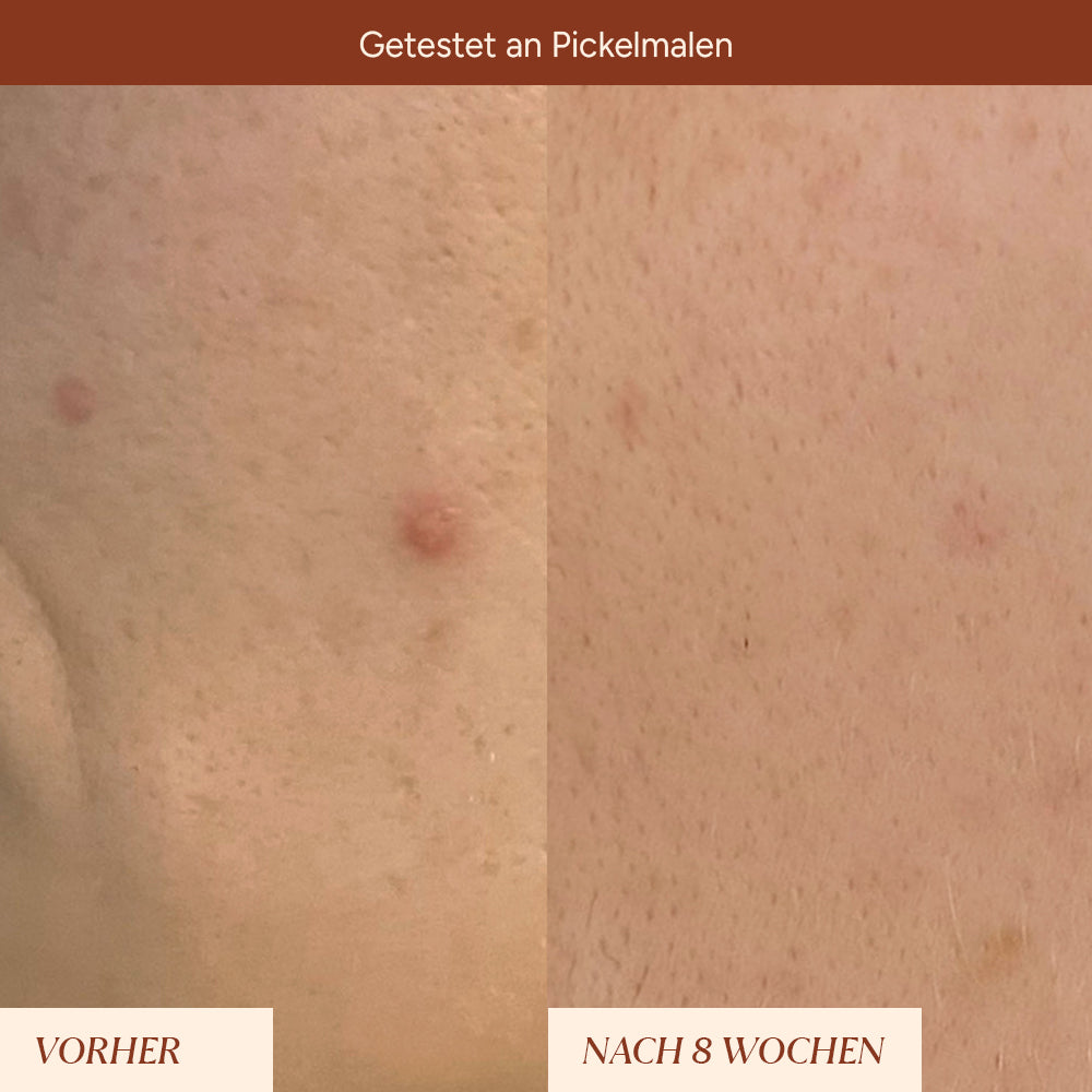 Pigmentflecken & Pickelmale Roll-On